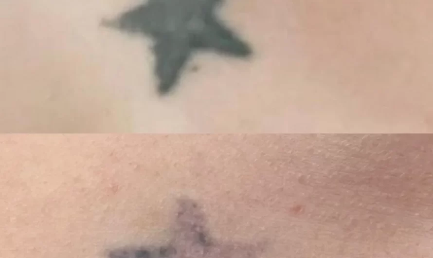 Tattoo Removal