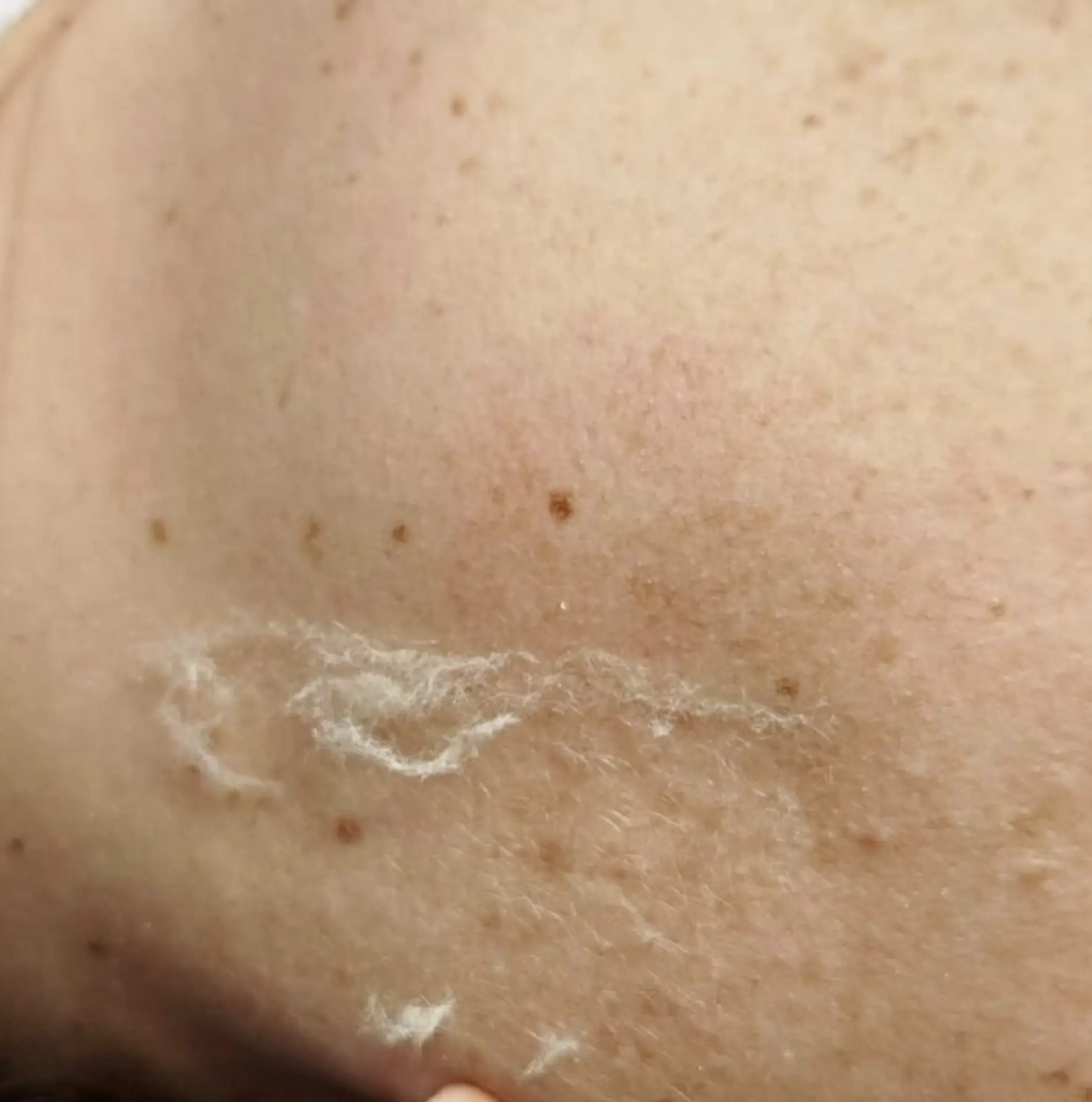 Before and after dermaplaning glow