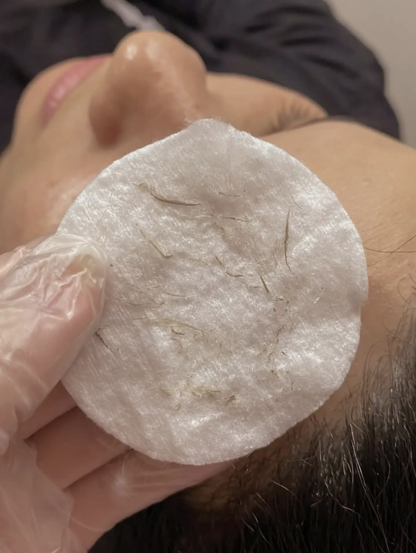 Facial redness after exfoliation treatment