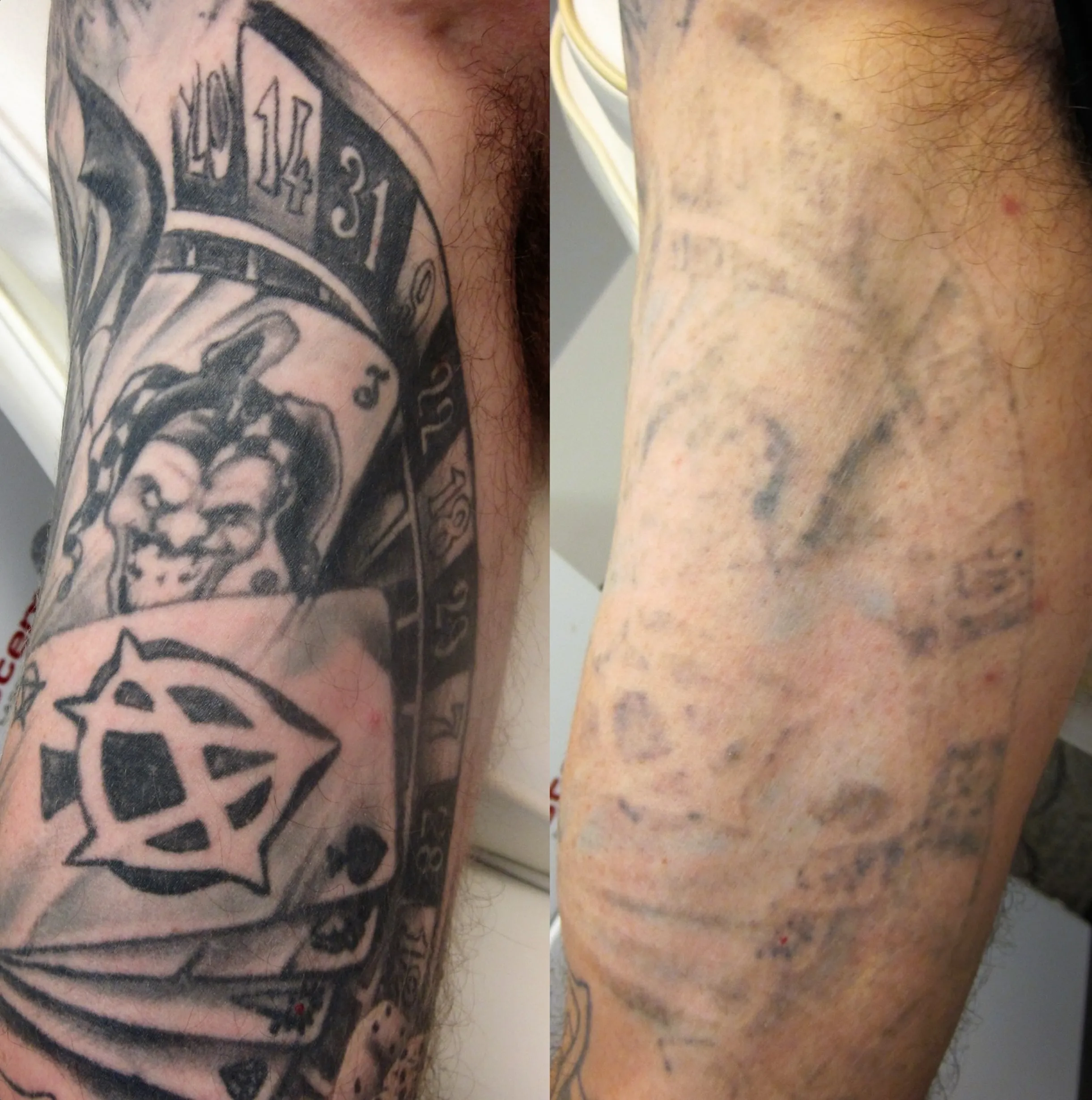 best way to fade tattoo at home