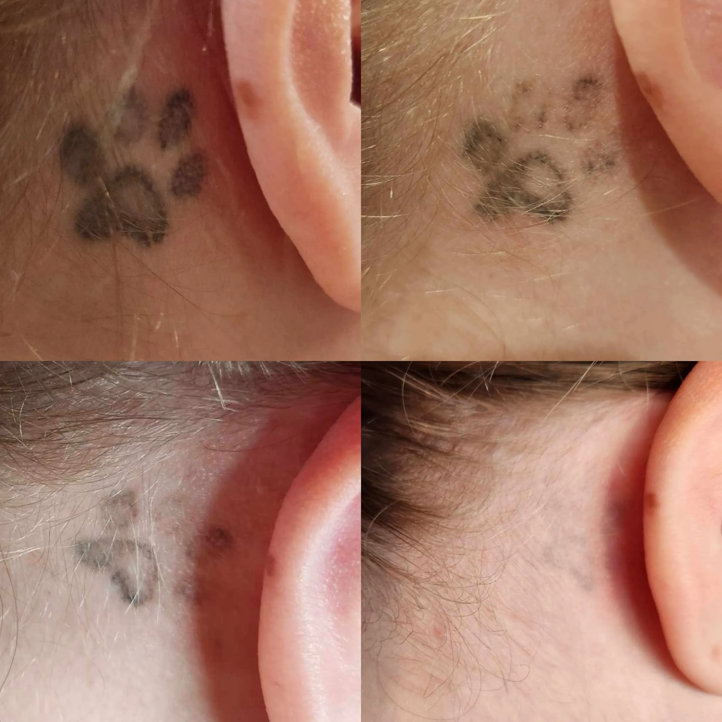 tattoo fading before laser