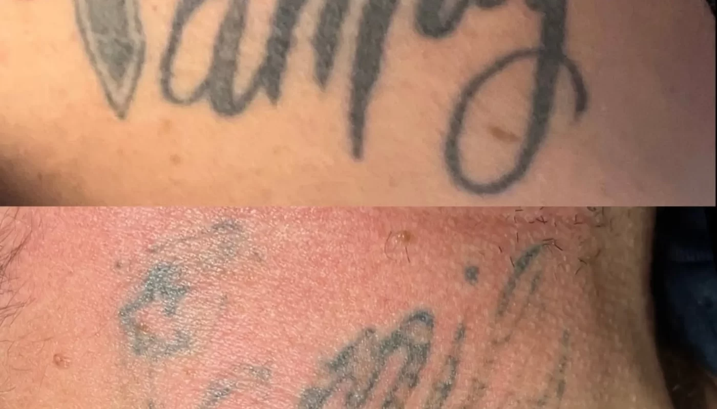 Can You Naturally Fade a Tattoo