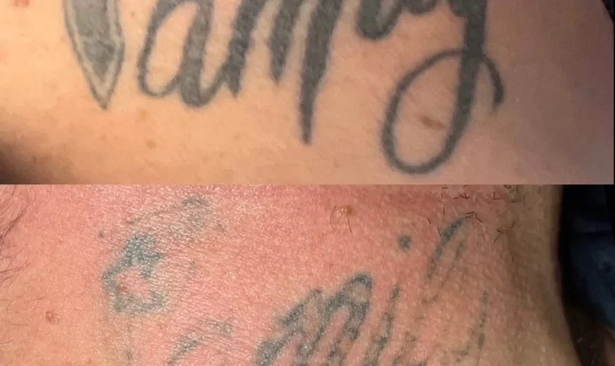 Can you naturally fade a tattoo?