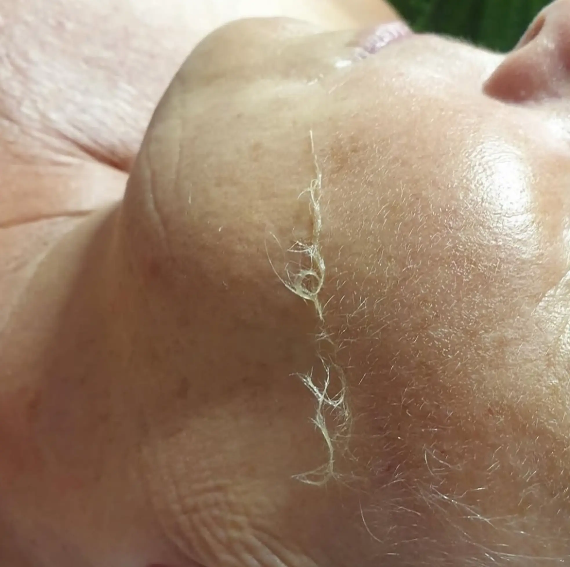 Sterile surgical scalpel for facial hair removal